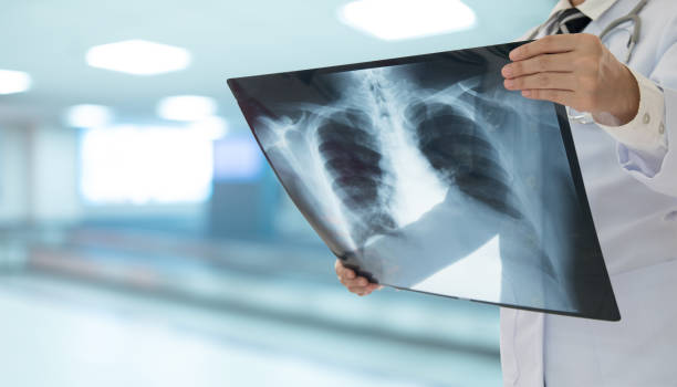 Radiographie pulmonaire.